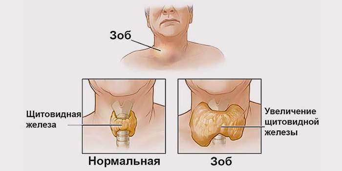 Bocio nodular tiroideo