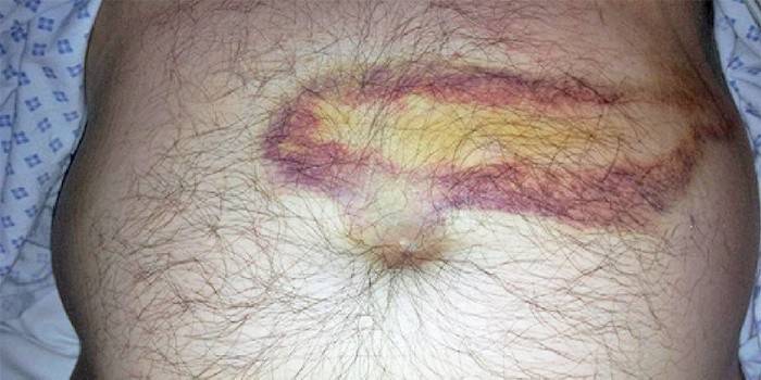 Manchas com pancreatite hemorrágica