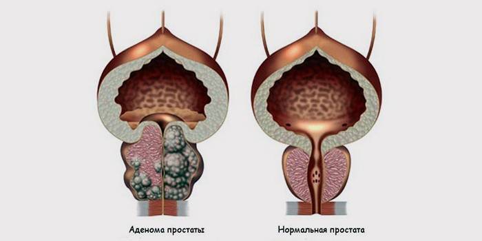 Próstata normal e adenoma