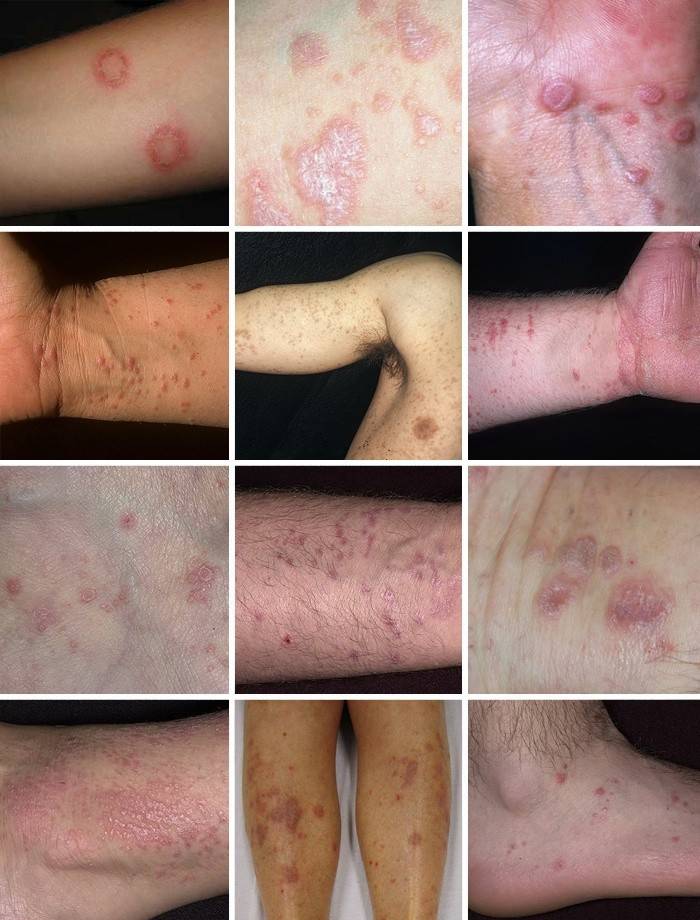 Lichen planus u ľudí