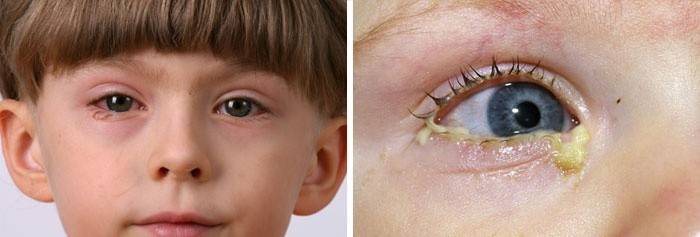 Pérdida de pestañas debido a infecciones oculares.