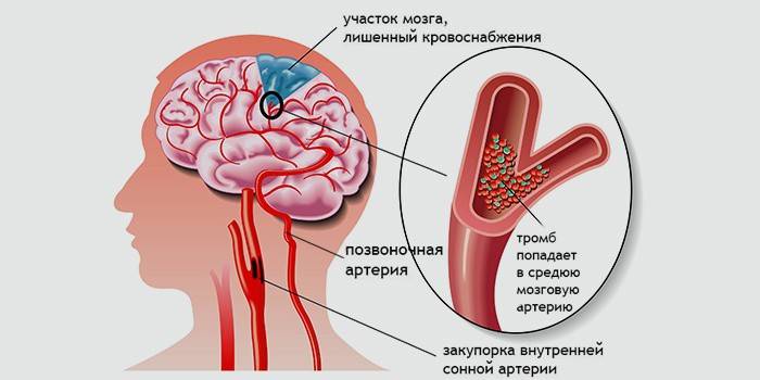 Niedrożność tętnic