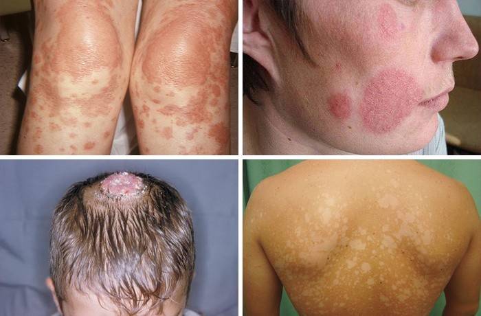 Príznaky pityriasis versicolor