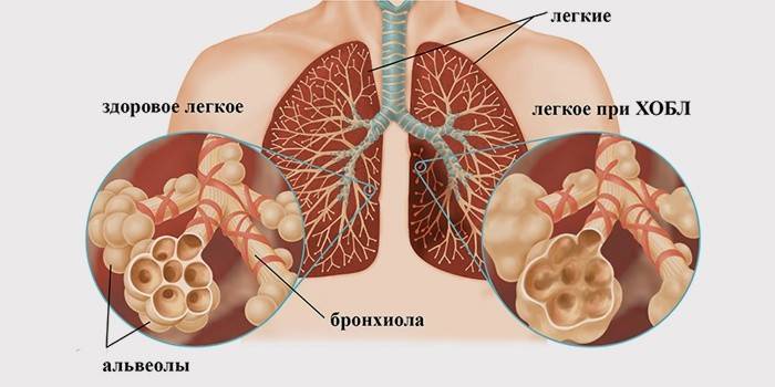 Síntomas de enfermedad pulmonar obstructiva crónica