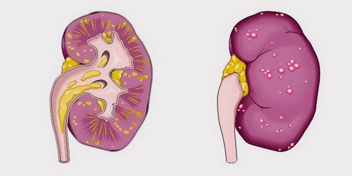 Pielonefritis aguda