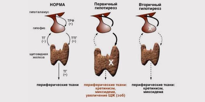 Etapy hypotyreózy štítnej žľazy