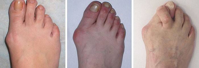 Bolí kosť na nohe: hallux valgus
