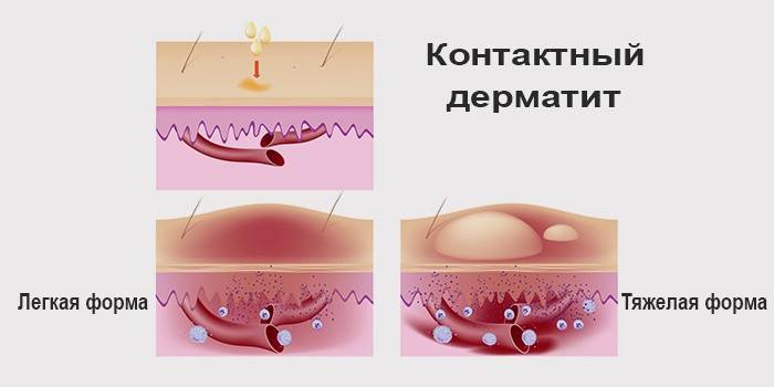 Formas de Dermatite de Contato Alérgica