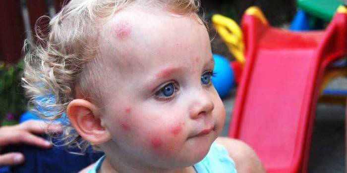Alergia na uštipnutie hmyzom
