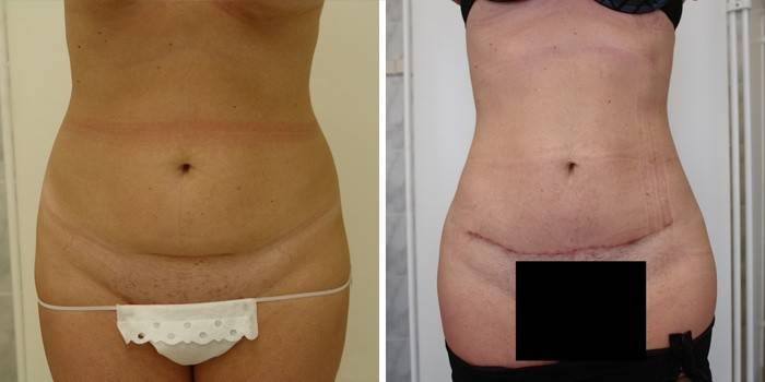 Abdomen después de la abdominoplastia