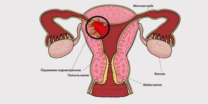 Sintomas de endometriose uterina