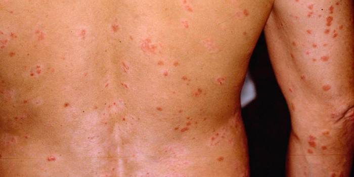 Známkou HIV u mužov je kožná vyrážka
