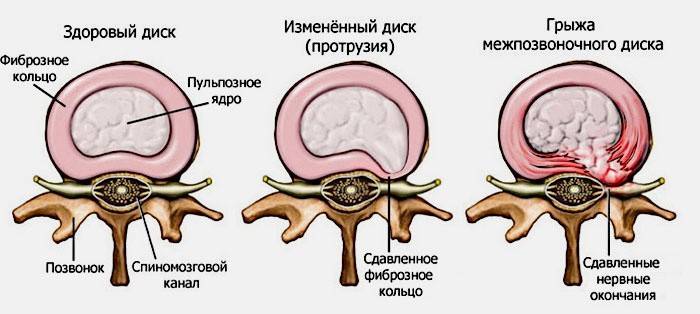 Hernia intervertebral: la causa de la ciática