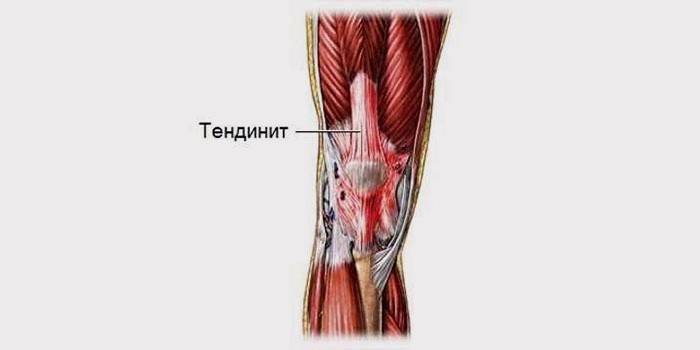 Localización del tendón en la articulación de la rodilla.