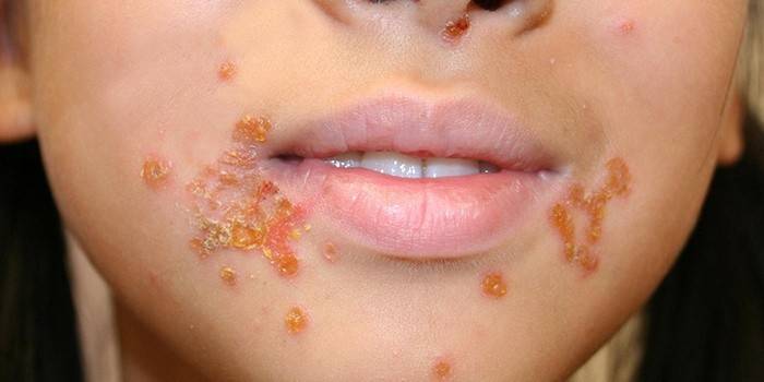 Pioderma estreptocócica em uma criança