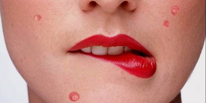 Acne no rosto de uma mulher