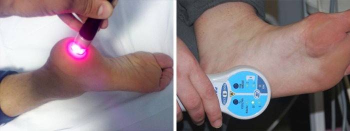 Laseroterapia