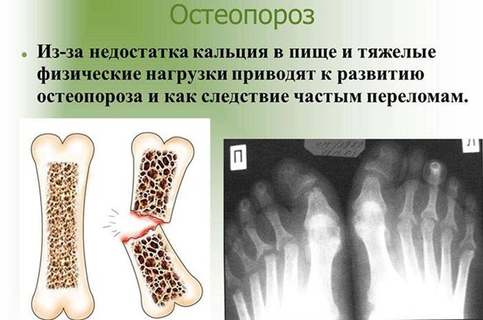 Bolesť pri osteoporóze