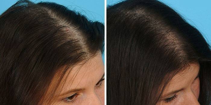 Cabello antes y después de la mesoterapia.