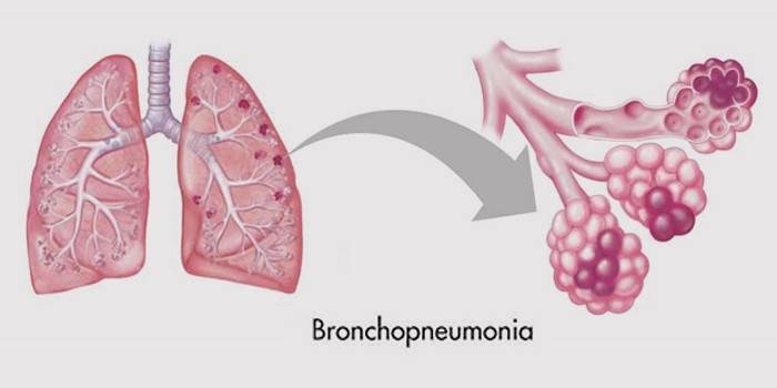 Pneumonia brônquica