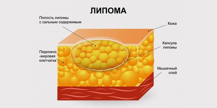 Estrutura lipoma