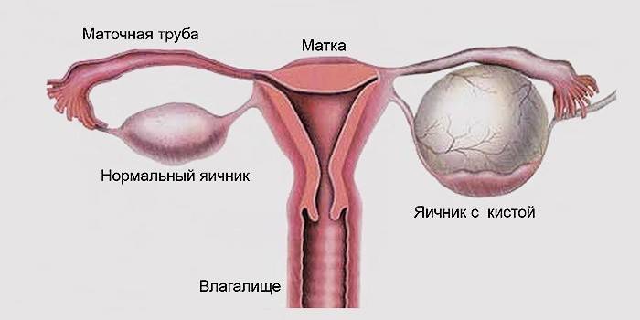 Ako vyzerá ovariálna cysta?