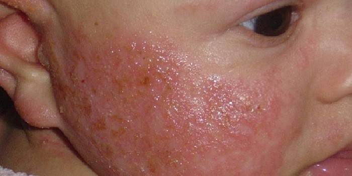 Alergia Alimentar em uma Criança