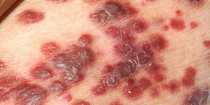 Nádory červeno-fialovej farby - nové štádium infekcie HIV