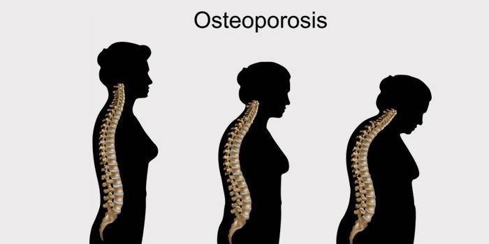 Osteoporóza chrbtice u žien