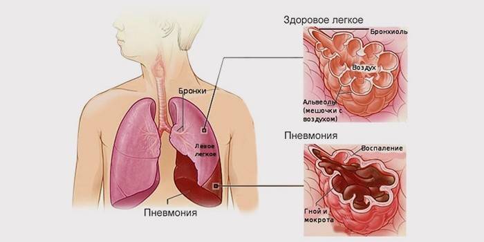 O que é pneumonia?