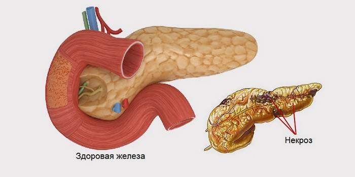 Necrose do tecido pancreático