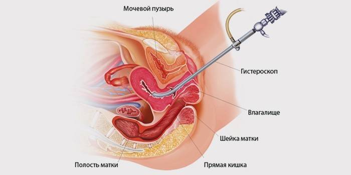 Odstránenie polypov v maternici
