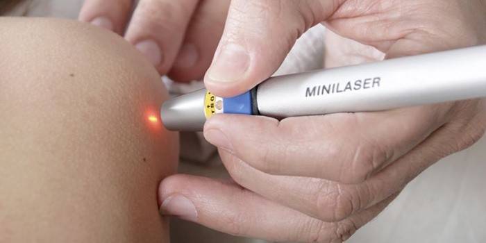 Remoção de pigmentação a laser