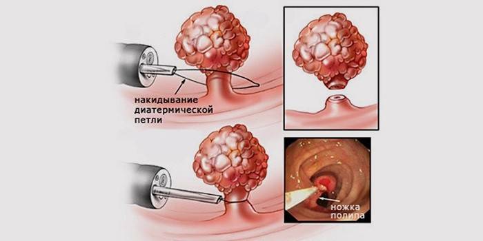 Polipektomia - usunięcie polipów z szyjki macicy