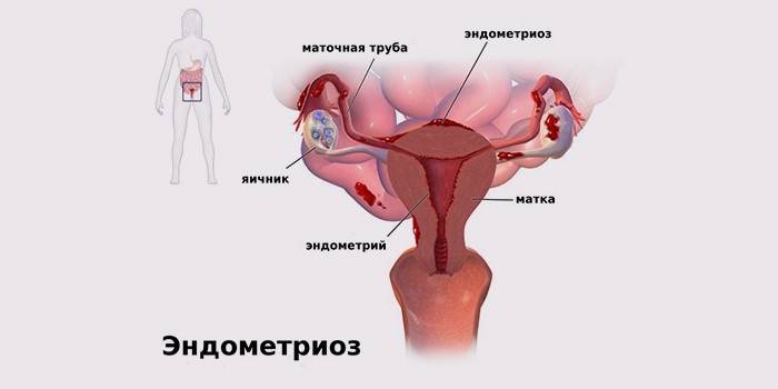 Endometrióza