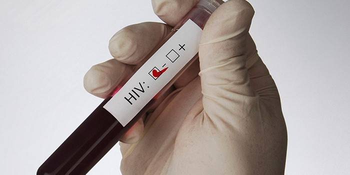 Test na HIV