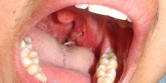 Signo de cáncer de garganta