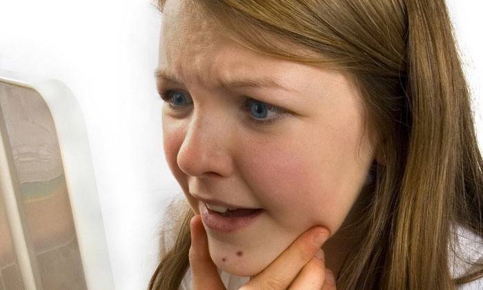 Acne em meninos e meninas no rosto