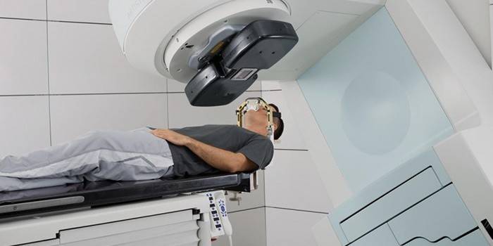 Tratamiento del cáncer de laringe con radioterapia.