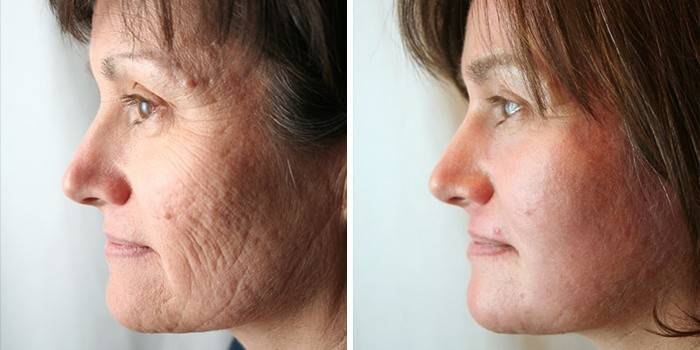 Rejuvenecimiento facial