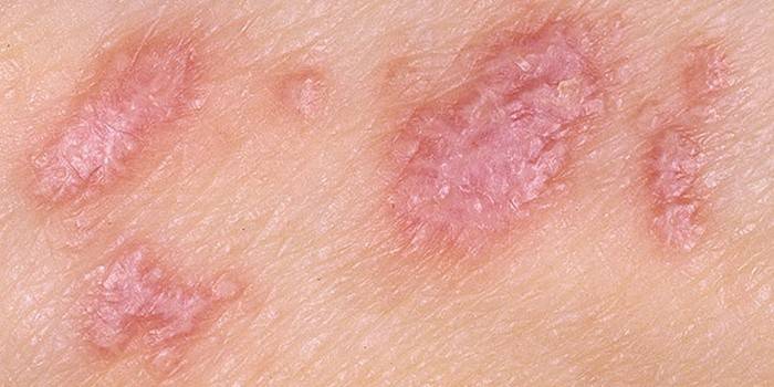 Lichen planus u ľudí