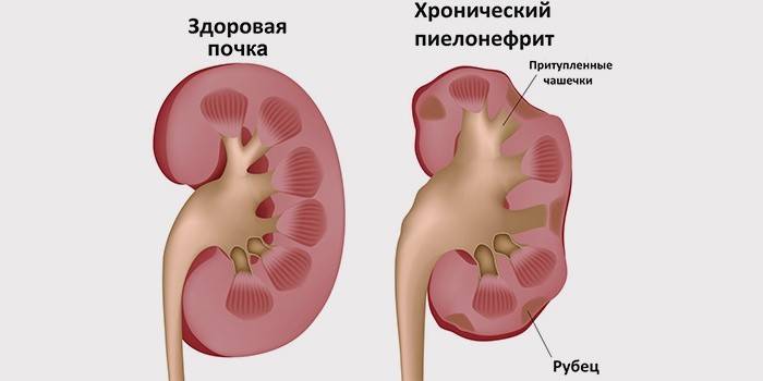 Síntomas de pielonefritis crónica.