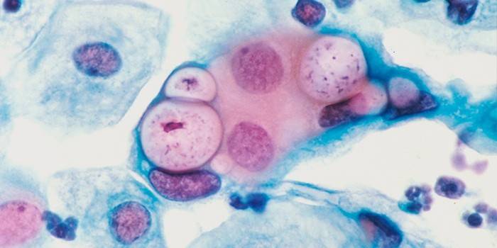Chlamydia u kobiet