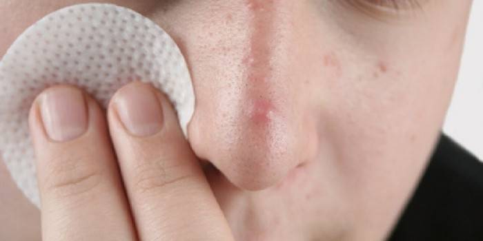 Acne no nariz