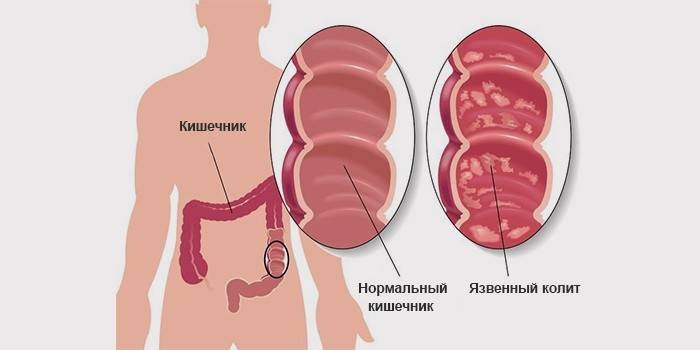Schematyczna ilustracja zdrowego jelita ludzkiego z objawami wrzodziejącego zapalenia jelita grubego