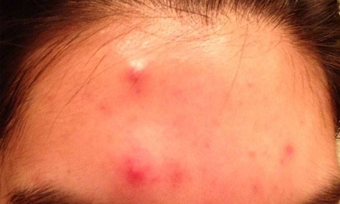 Acne com focos de infecção