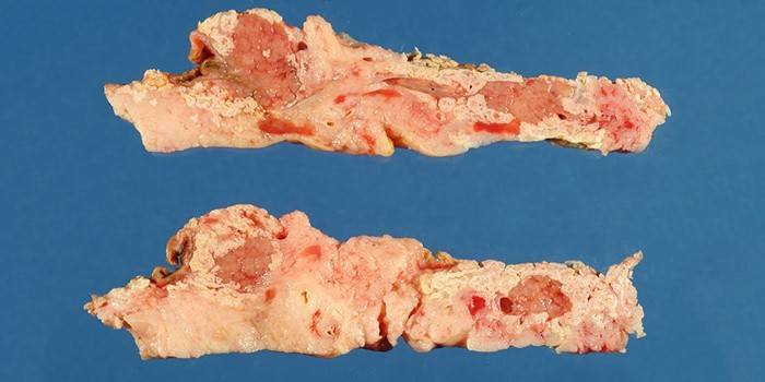 Necrose pancreática