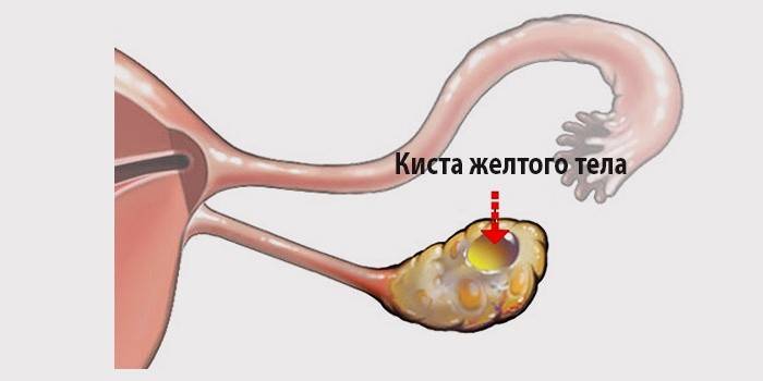 Representação esquemática do cisto do corpo lúteo ovariano