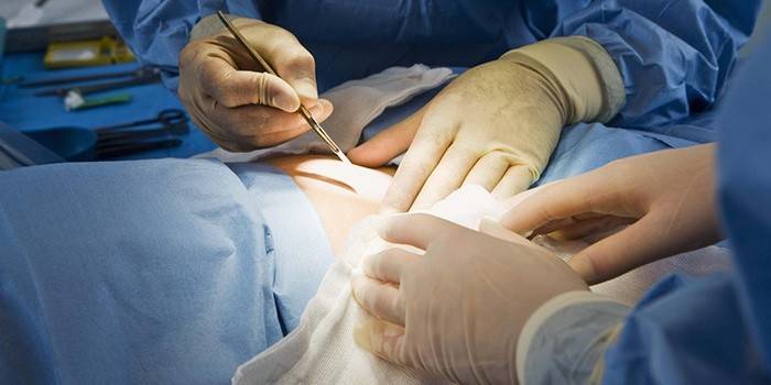 Abdominoplastia clásica del abdomen