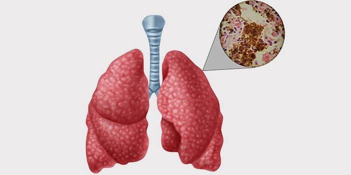 Tuberculose pulmonar